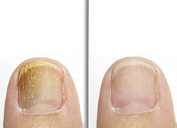 Gesunder Fuß - Anti-Fuß- und Nagelpilzspray, in Farbe  Ansicht 3