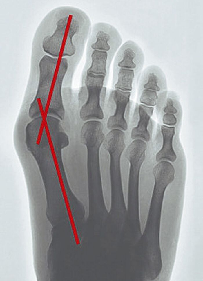 "epitact" Korrekturorthese Hallux-Valgus HAUTFARBEN