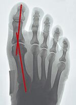 "epitact" Korrekturorthese Hallux-Valgus HAUTFARBEN