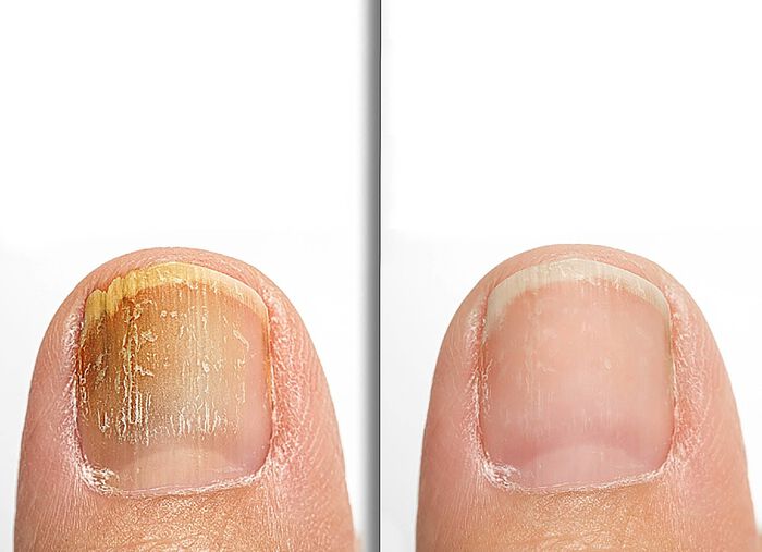 Anti-Fu&szlig;- und Nagelpilzspray 