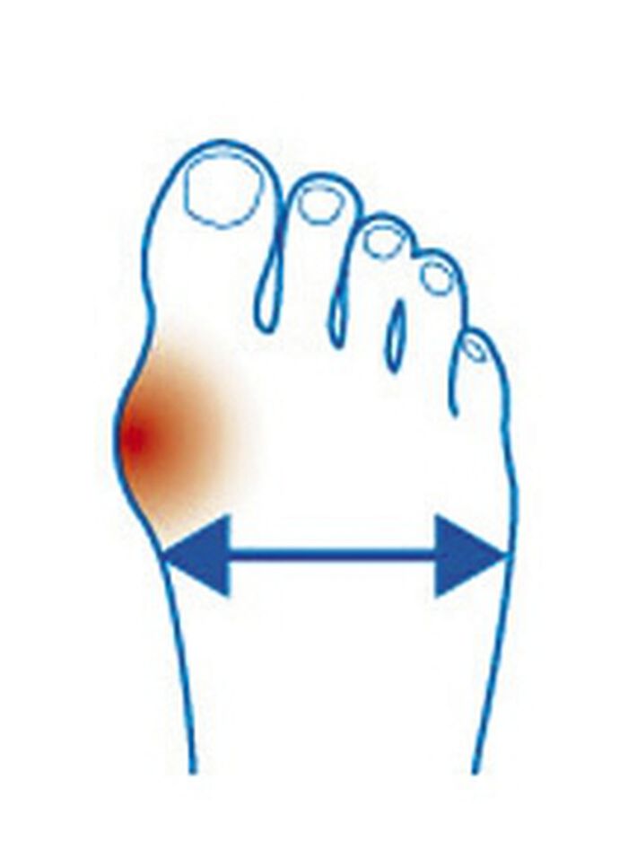 "epitact" Korrekturorthese Hallux-Valgus HAUTFARBEN